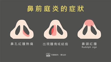 鼻孔裡面有一顆|鼻內「痘」腫痛？ 當心「鼻前庭炎」惡化